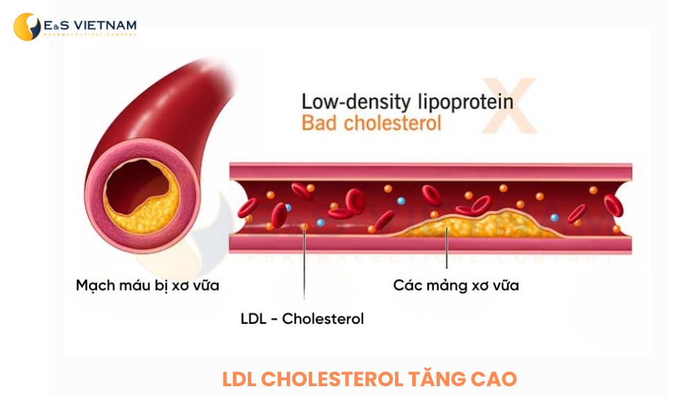 LDL tăng cao gây xơ vữa mạch máu